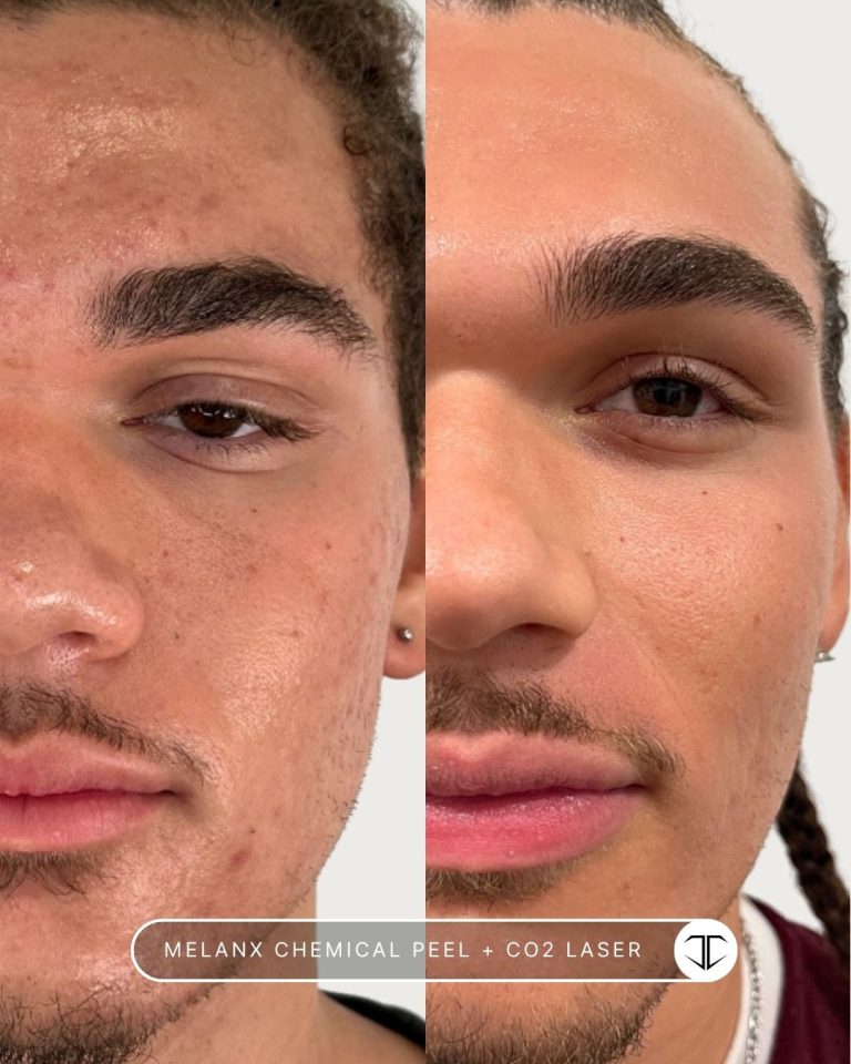 Melanx Chemical Peel + Co2 Laser Before and After
