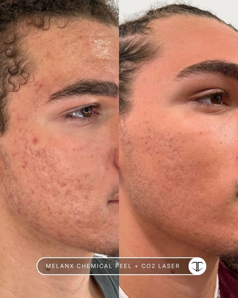 Melanx Chemical Peel + Co2 Laser Before and After