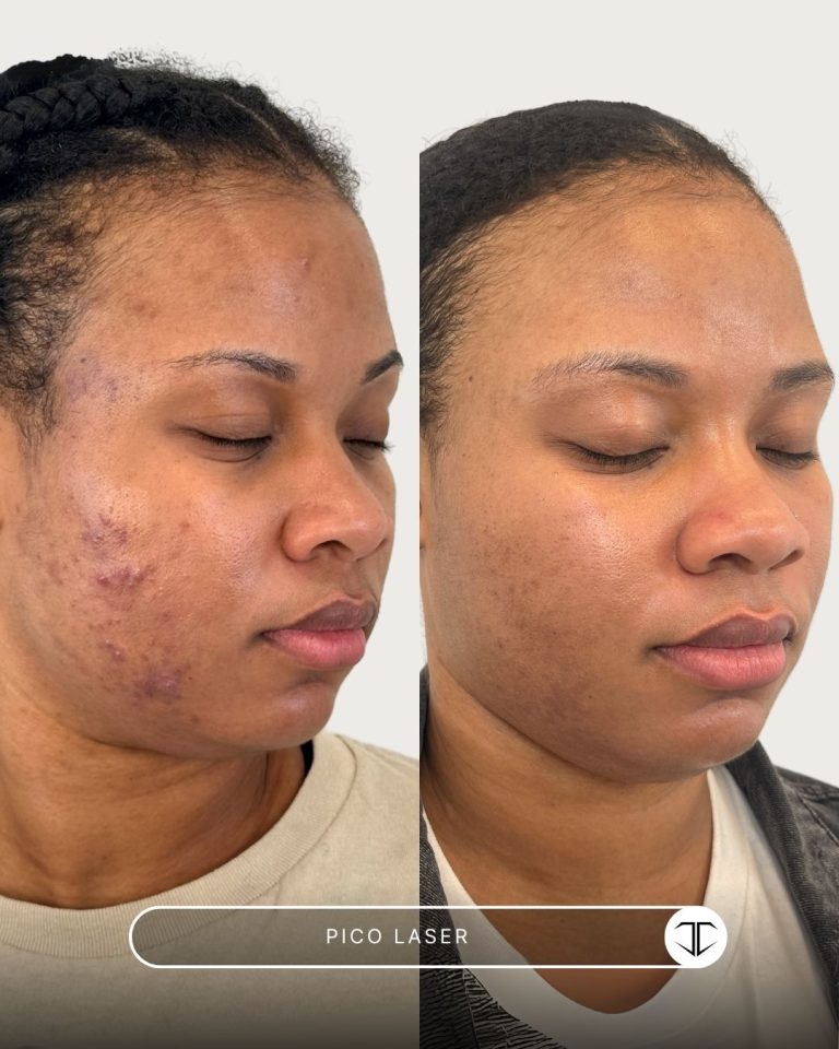 Pico Laser Before and After