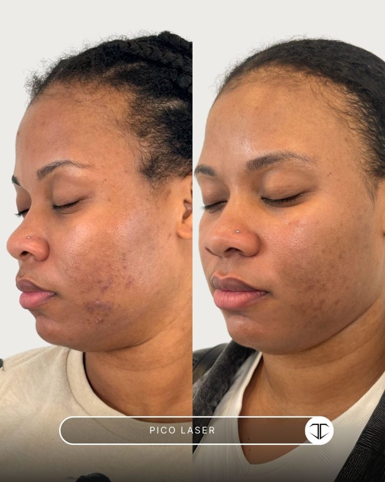 Pico Laser Before and After