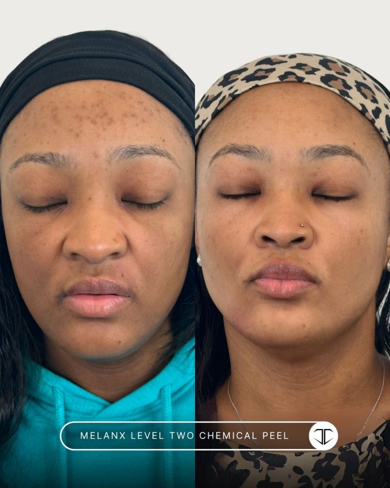 Melanx Level 2 Chemical Peel Before and After