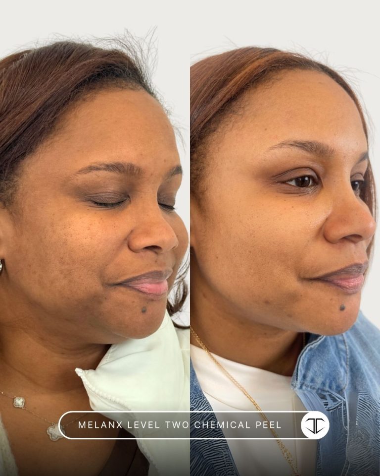 Melanx Level 2 Chemical Peel Before and After
