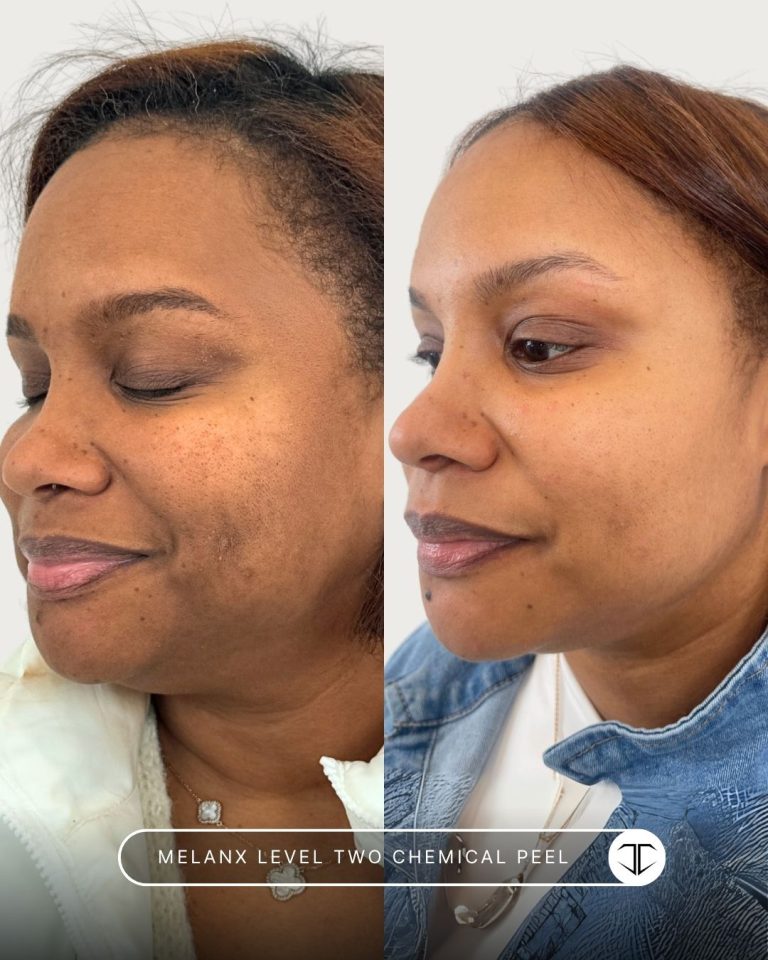 Melanx Level 2 Chemical Peel Before and After