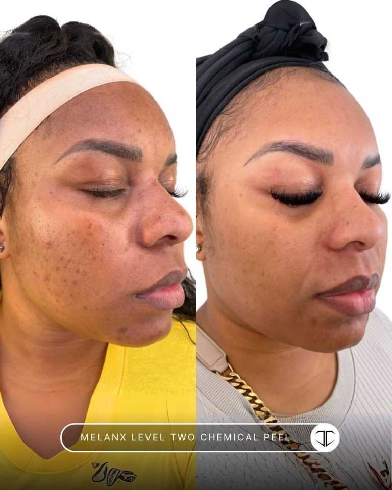Melanx Level 2 Chemical Peel Before and After