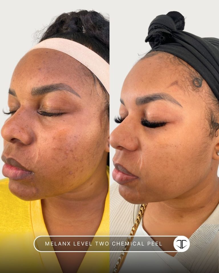 Melanx Level 2 Chemical Peel Before and After