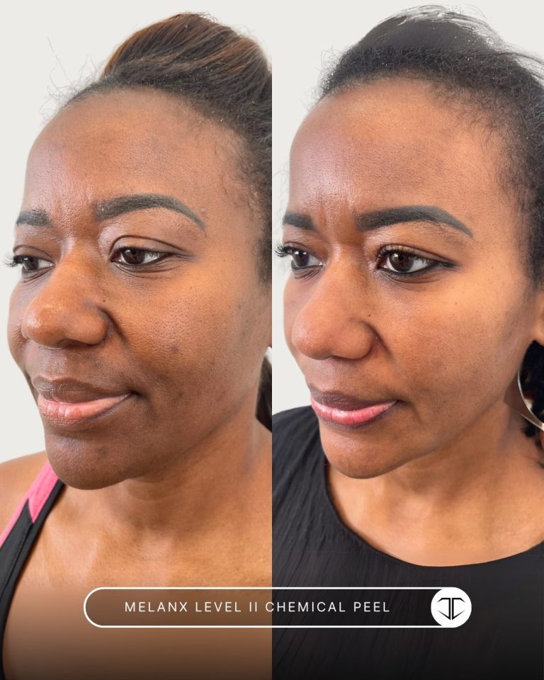 Melanx Level 2 Chemical Peel Before and After