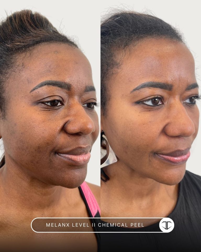 Melanx Level 2 Chemical Peel Before and After