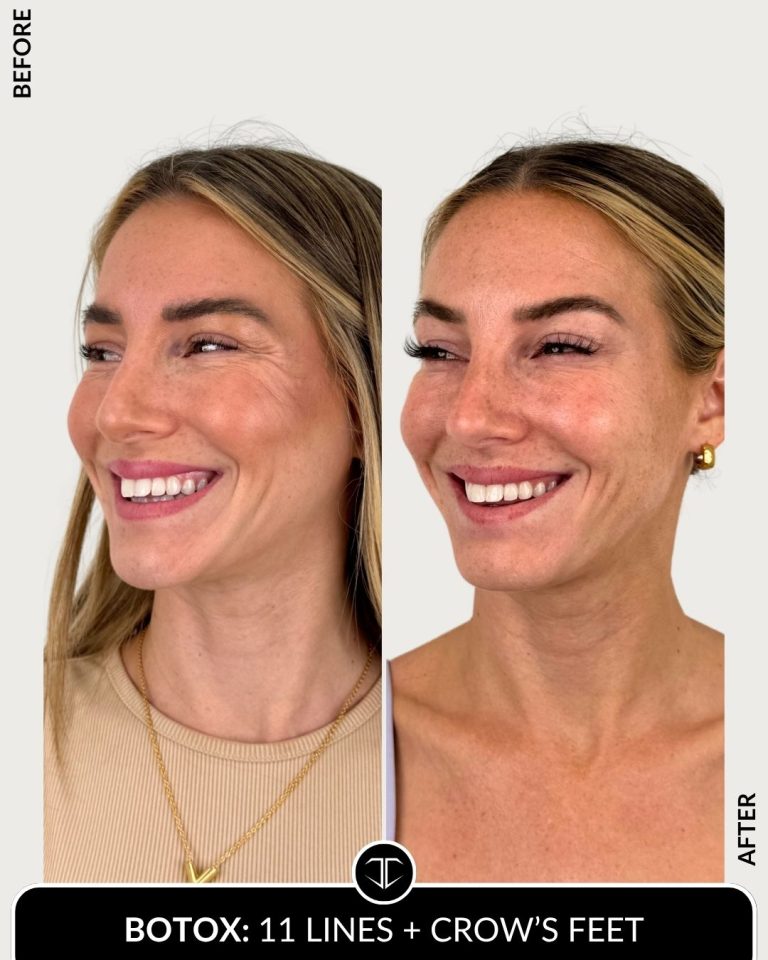 Botox Before and After