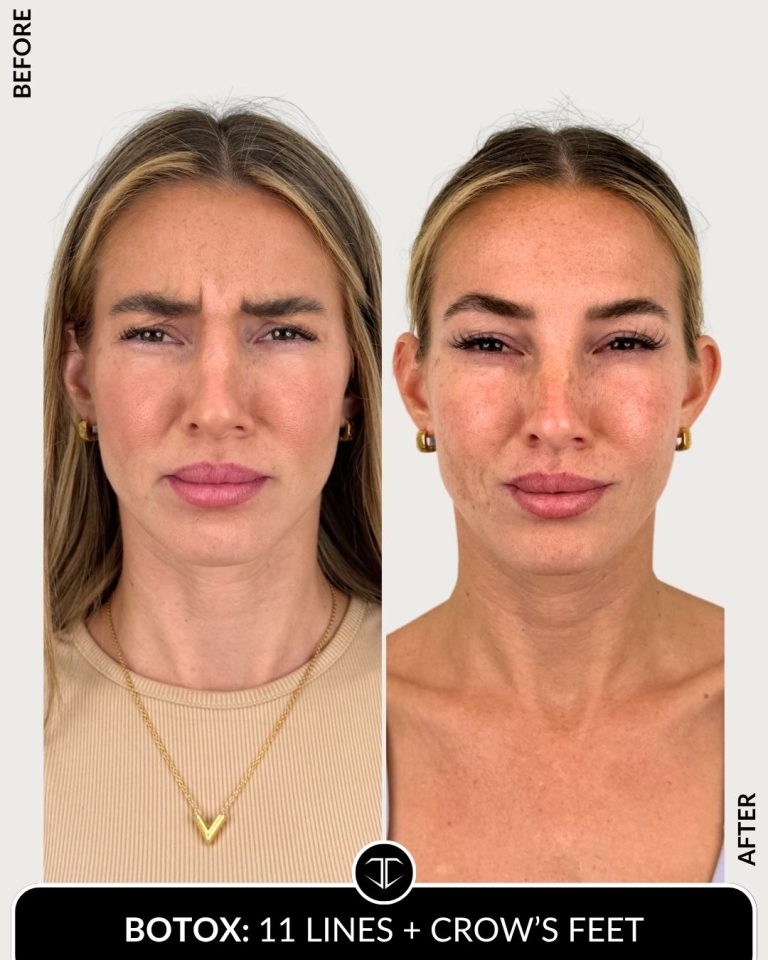 Botox Before and After