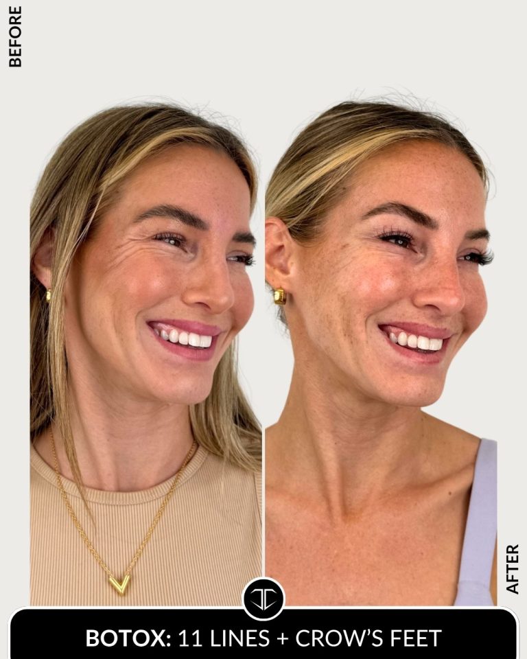 Botox Before and After
