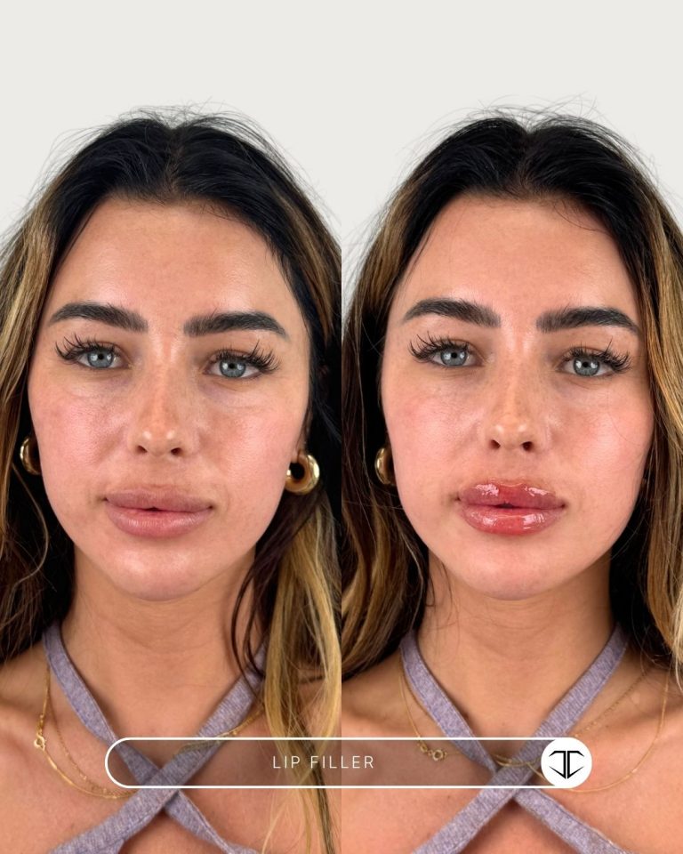 Lip Filler Before and After