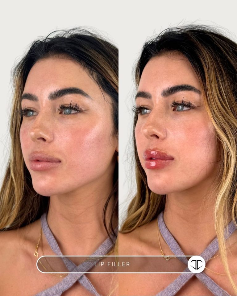 Lip Filler Before and After