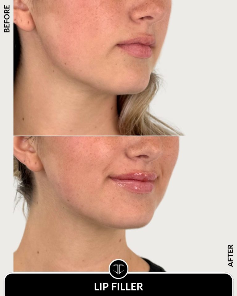 Lip Filler Before and After