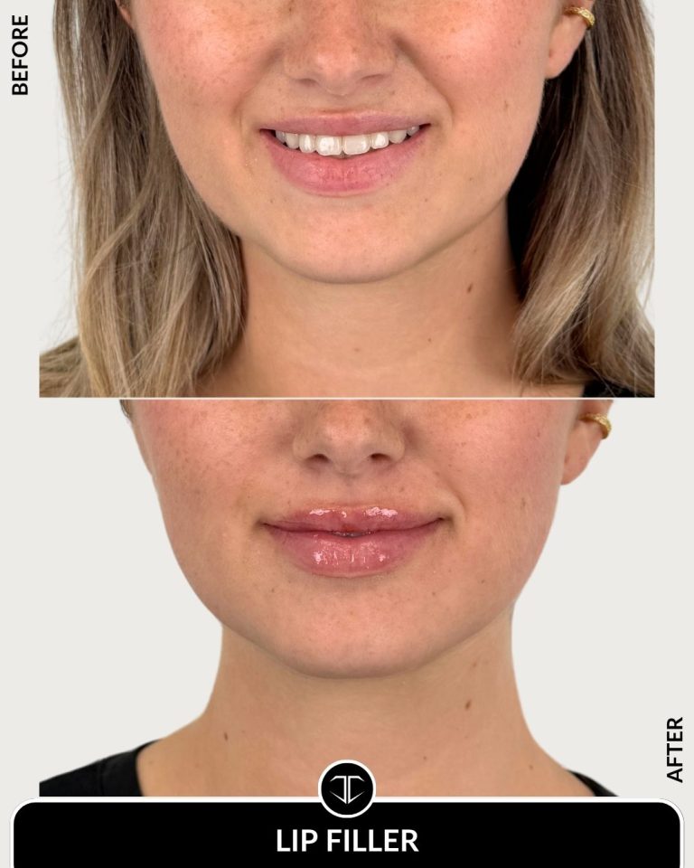 Lip Filler Before and After