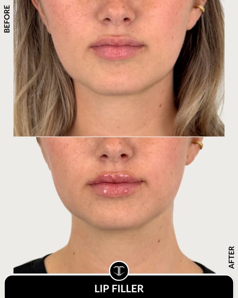 Lip Filler Before and After