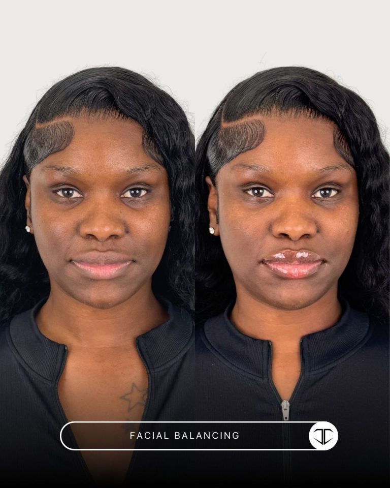 Facial Balancing Before and After