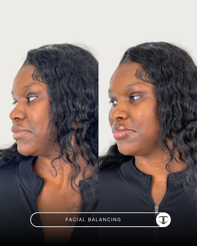 Facial Balancing Before and After