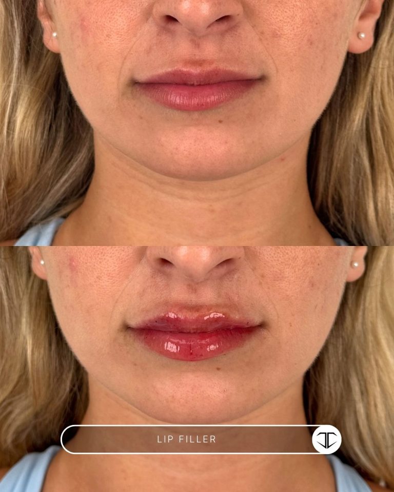 Lip Filler Before and After