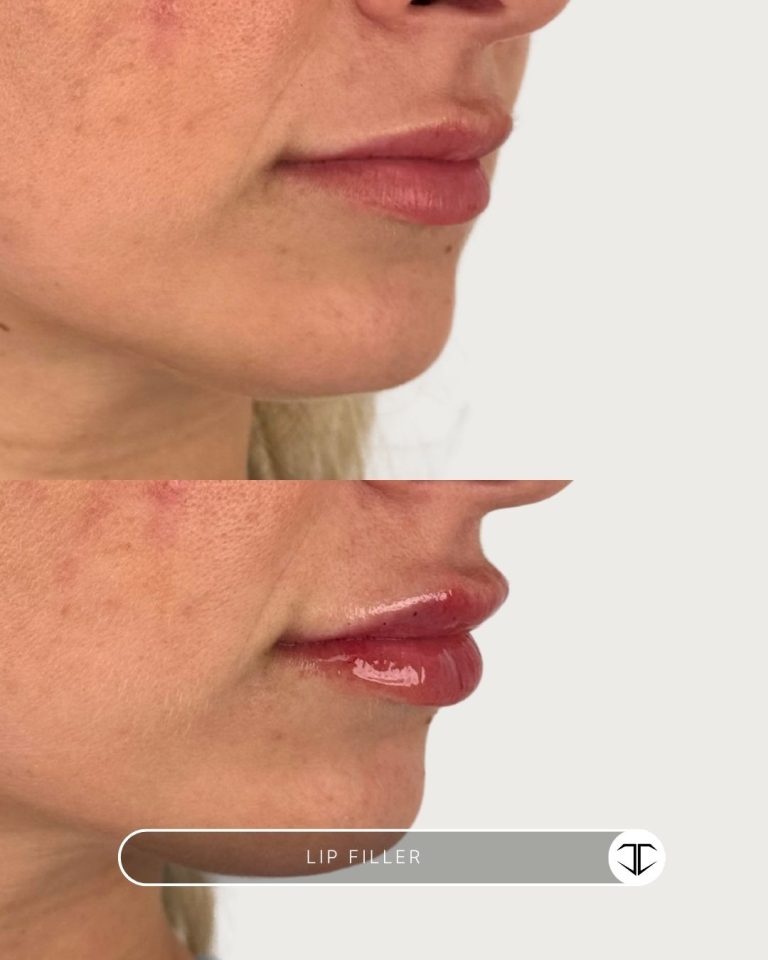 Lip Filler Before and After