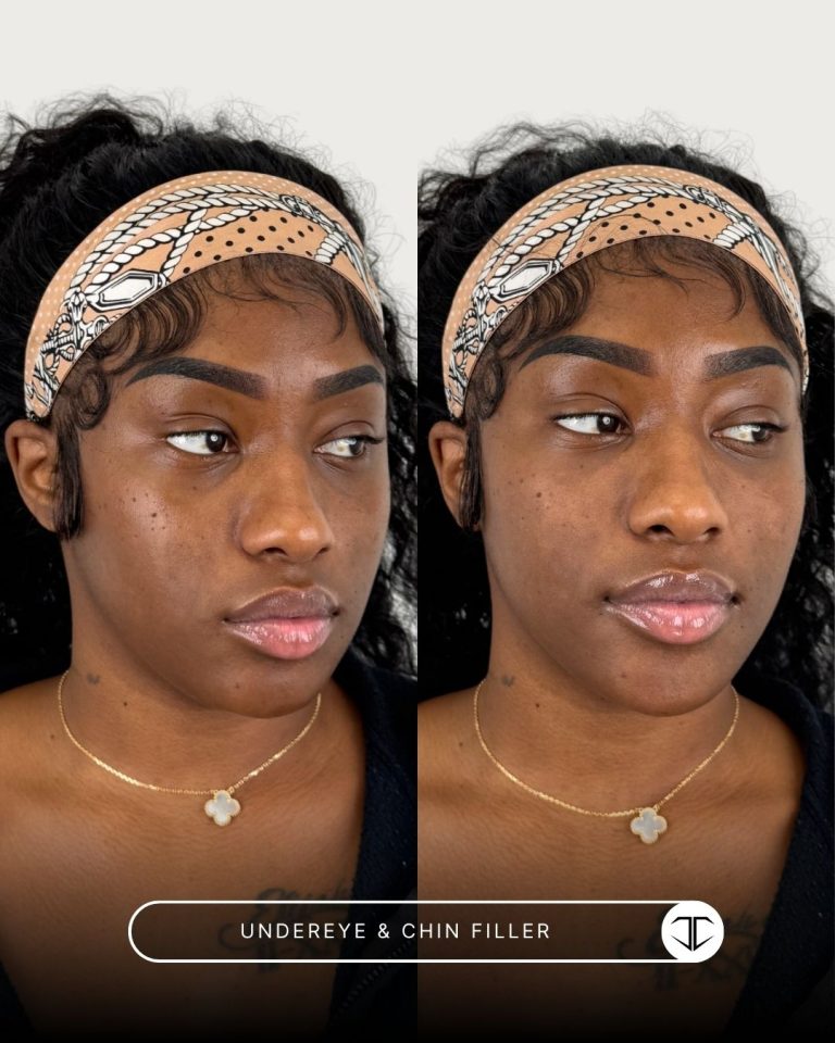 Undereye and Chin Filler Before and After