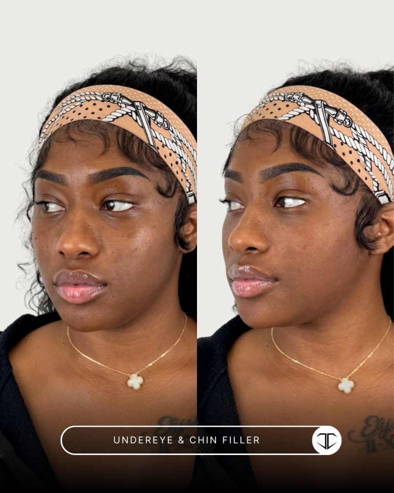 Undereye and Chin Filler Before and After