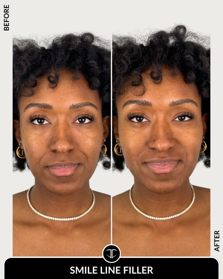 Smile Line Filler Before and After