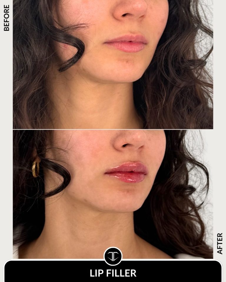 Lip Filler Before and After
