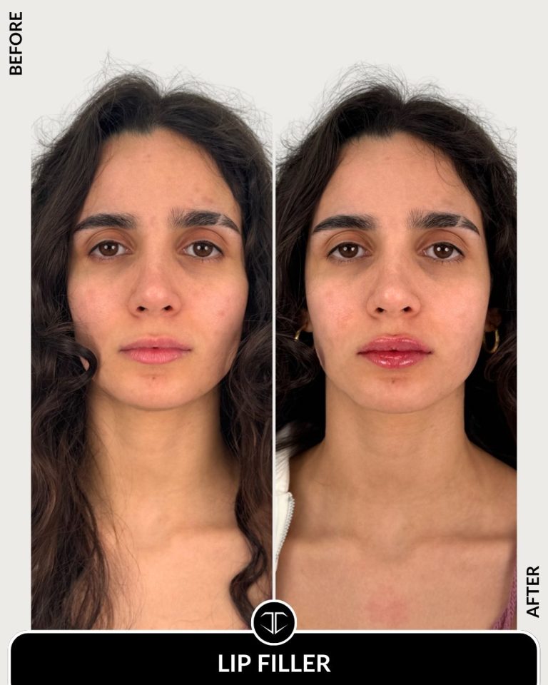 Lip Filler Before and After