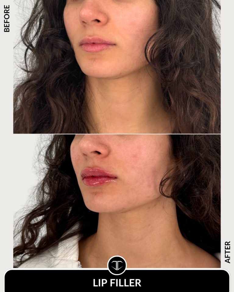 Lip Filler Before and After