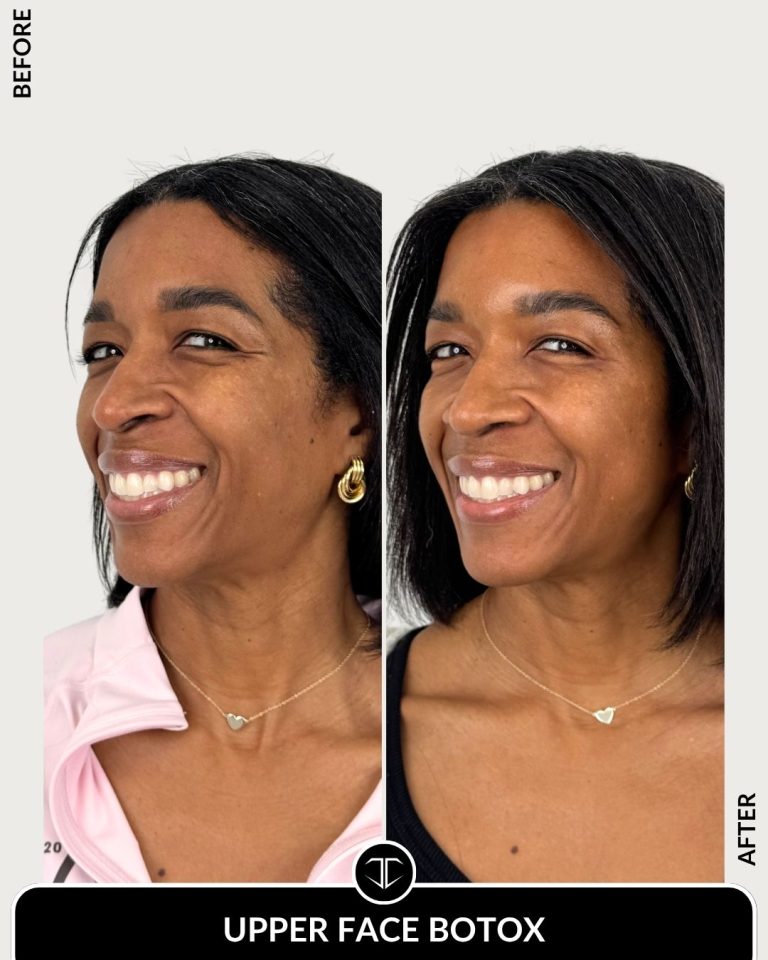 Botox Before and After