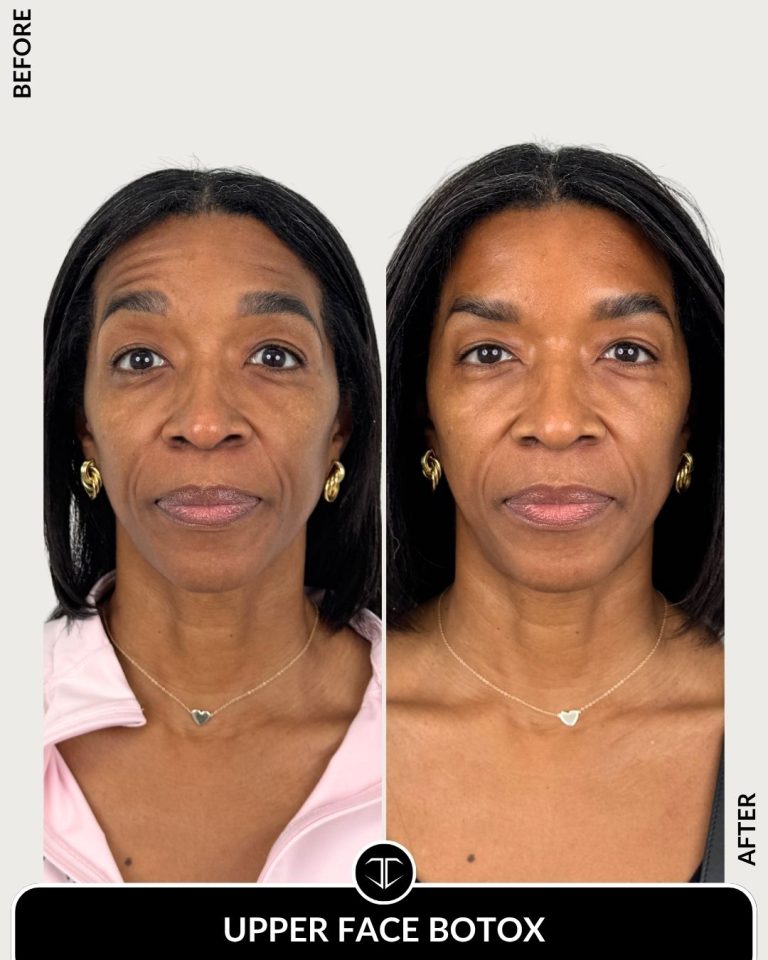 Botox Before and After