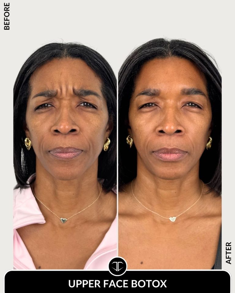 Botox Before and After