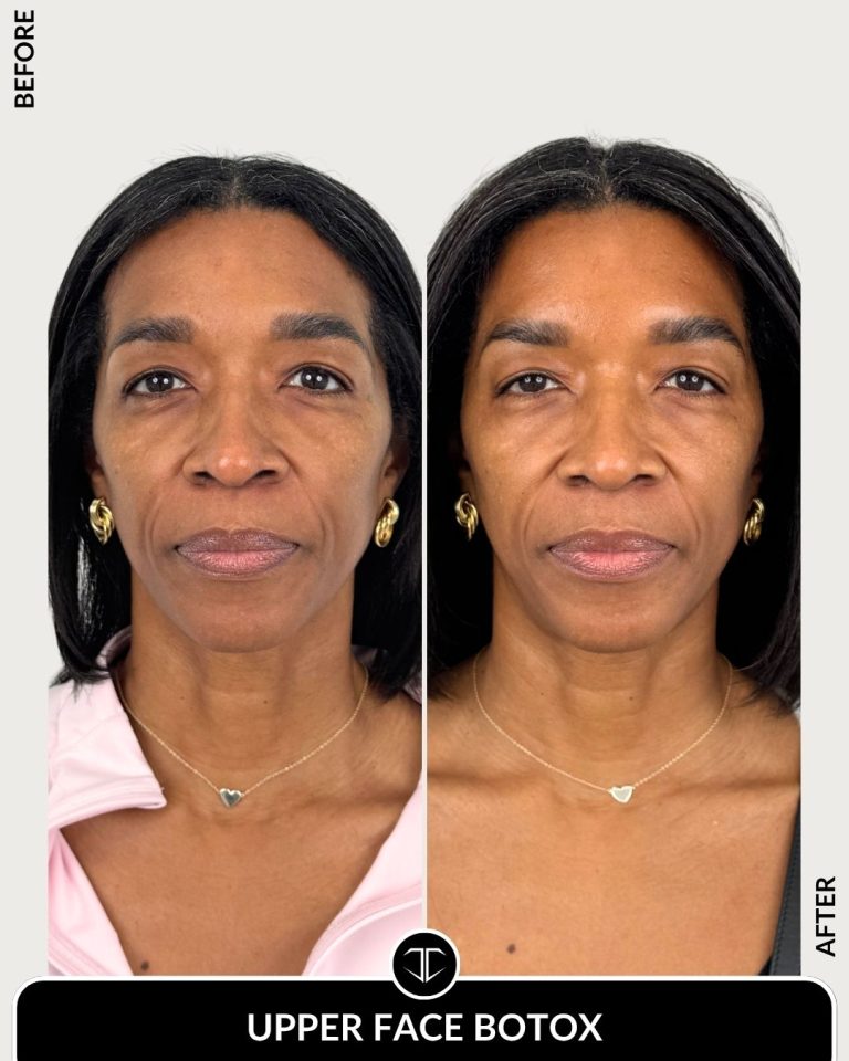 Botox Before and After