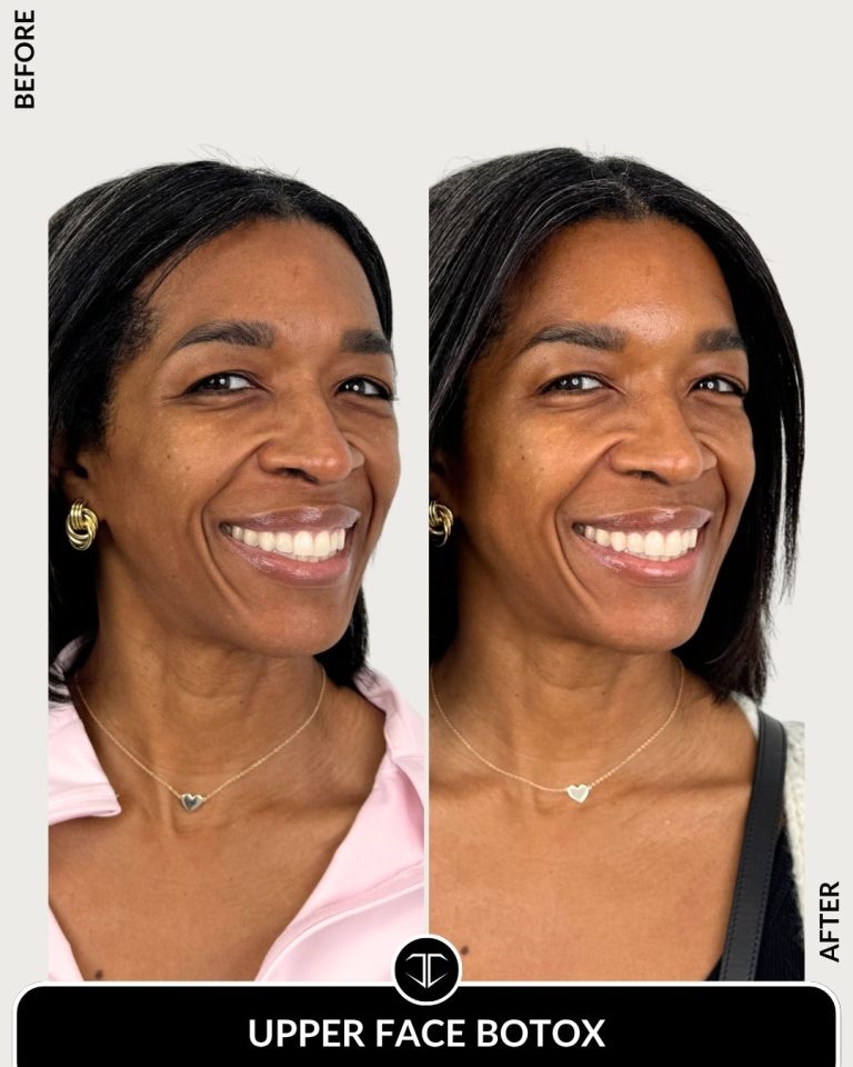 Botox Before and After