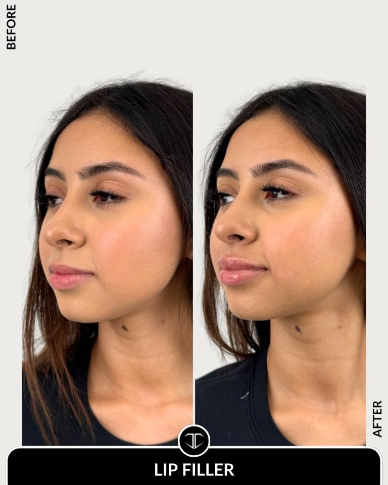 Lip Filler Before and After