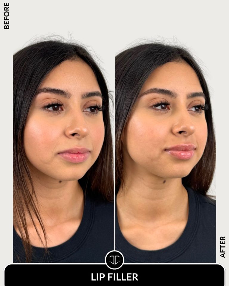 Lip Filler Before and After