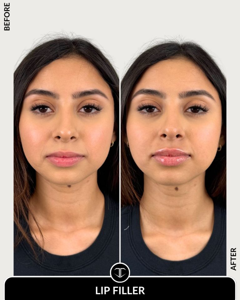 Lip Filler Before and After